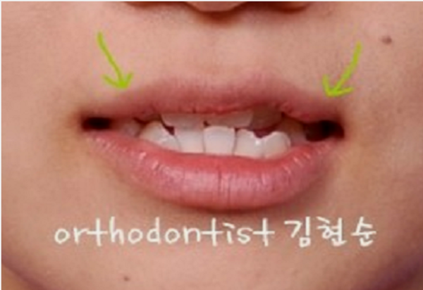 강남 덧니 관련 이미지 6