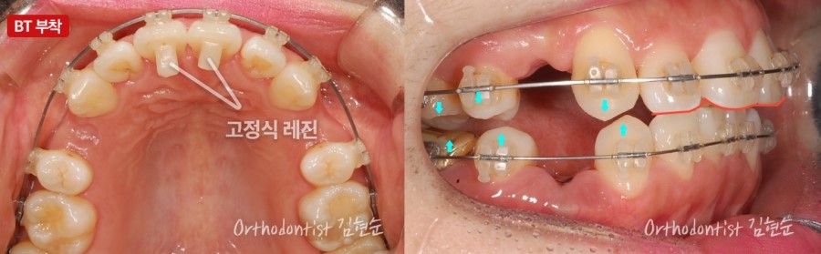 과개교합 무턱 개선 관련 이미지 9