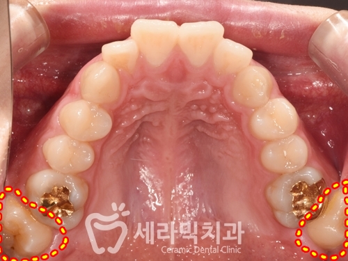 과개교합과 돌출입 개선으로 달라진 인상, 세라믹치과 치아교정전후! 관련 이미지 6