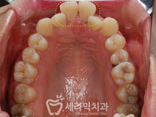 돌출입, 치열불규칙, 치아상실 치아교정과 임플란트 전후 관련 이미지 3