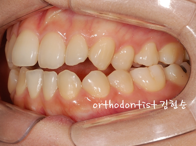 개방 교합 관련 이미지 10
