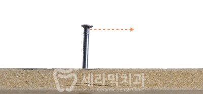 치아교정 부작용 제대로 알기 1. 관련 이미지 4