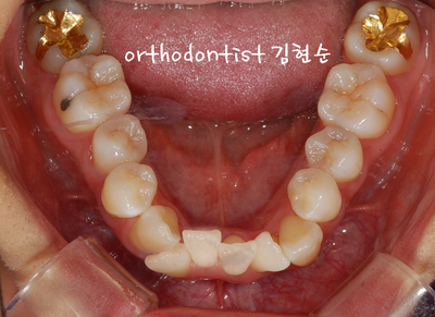 강남 덧니 관련 이미지 8