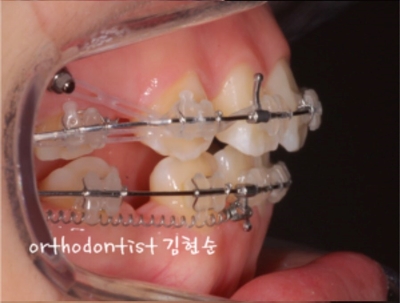 강남치아교정추천 관련 이미지 18