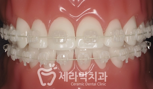 치아교정과 라미네이트는 선택이 아닌 상호 보완관계! 관련 이미지 2