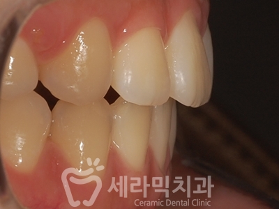 돌출입과 개방교합 치아교정 치료전후 관련 이미지 20