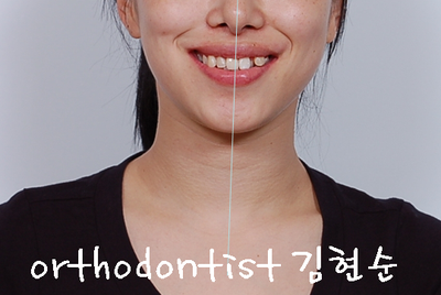 강남 덧니, 돌출 관련 이미지 3