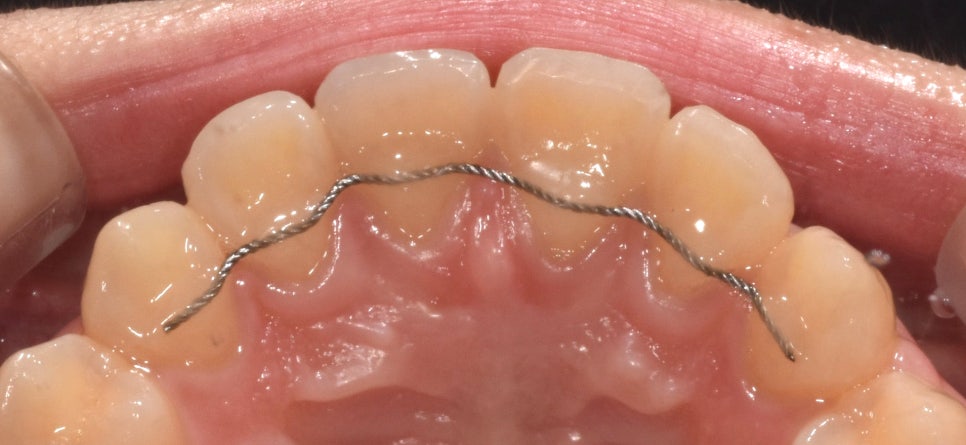 개방교합은 재발률이 높다? 치아교정 후 관리방법 (feat.유지장치) 관련 이미지 5