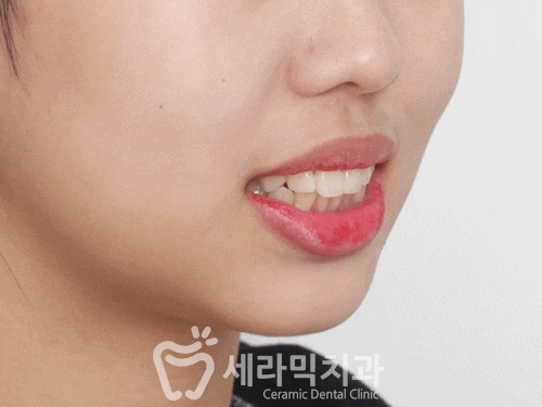 돌출입 치아교정전후. 갸름하고 세련된 입술을 되찾다! 관련 이미지 3