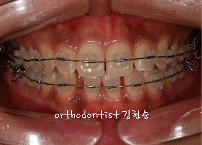 치열 교정 ( 벌어짐 ) 관련 이미지 15
