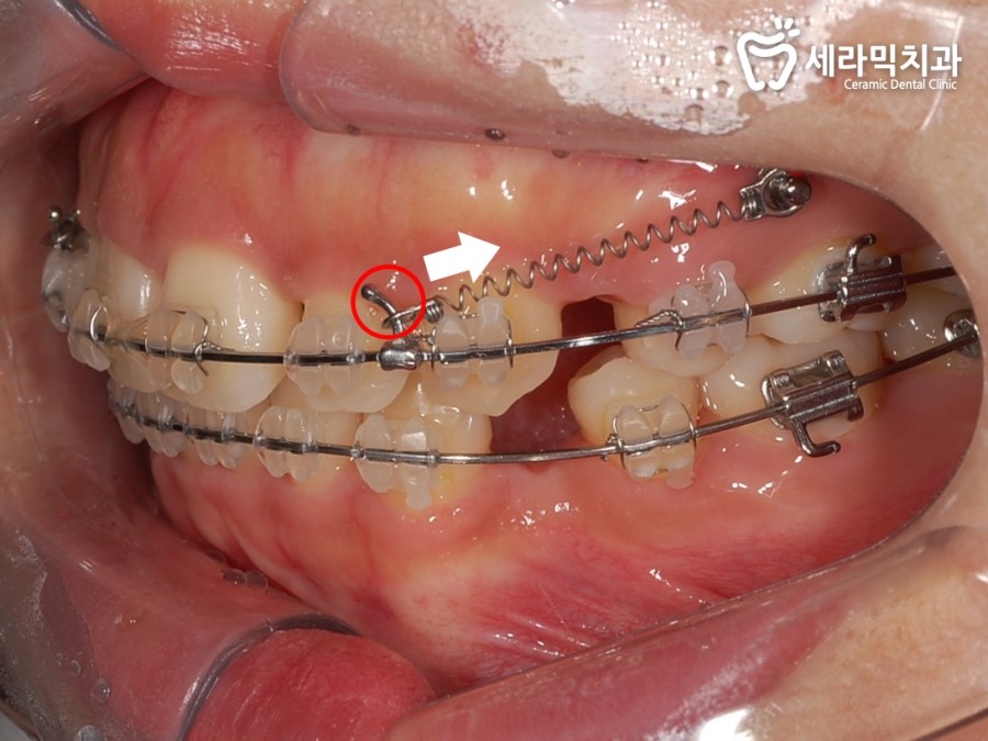 돌출입 교정으로 외모변화를 확인 관련 이미지 4