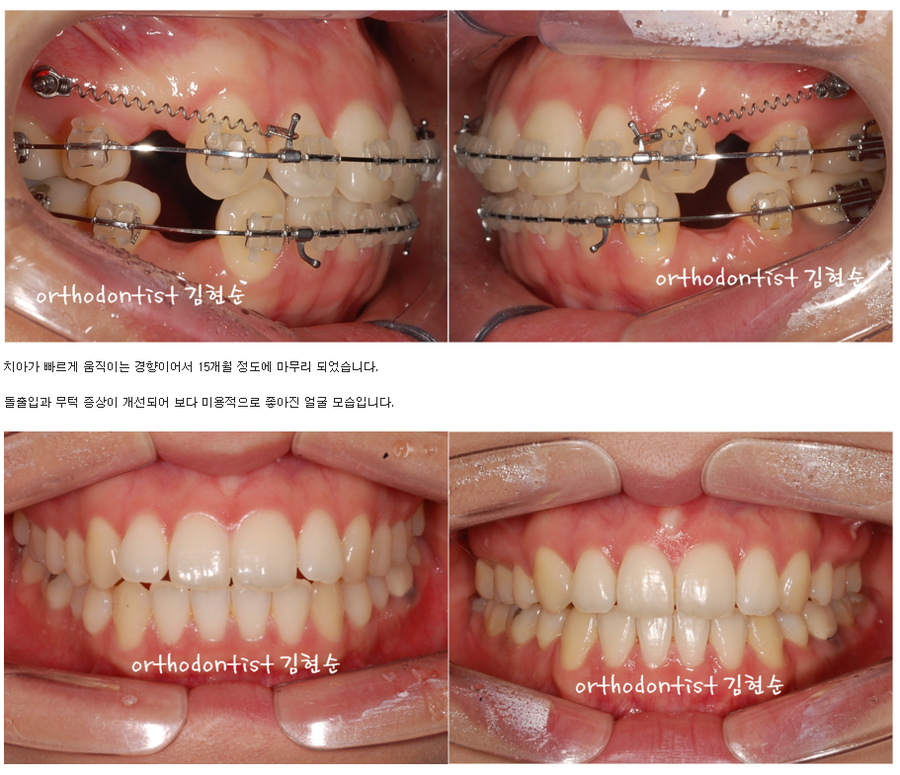 세라믹교정 세라믹치과-돌출입발치교정 6 관련 이미지 5