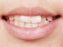 학동역 치아교정, 수술없이 예뻐져도 되나요? [돌출입교정 전후 달라진 외모] 관련 이미지 6