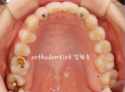 개방 교합 관련 이미지 27