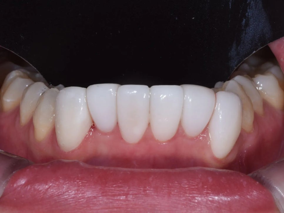 세라믹 치과, 삐뚤빼뚤한 치아를 교정 없이 라미네이트로 치료한 사례 관련 이미지 8