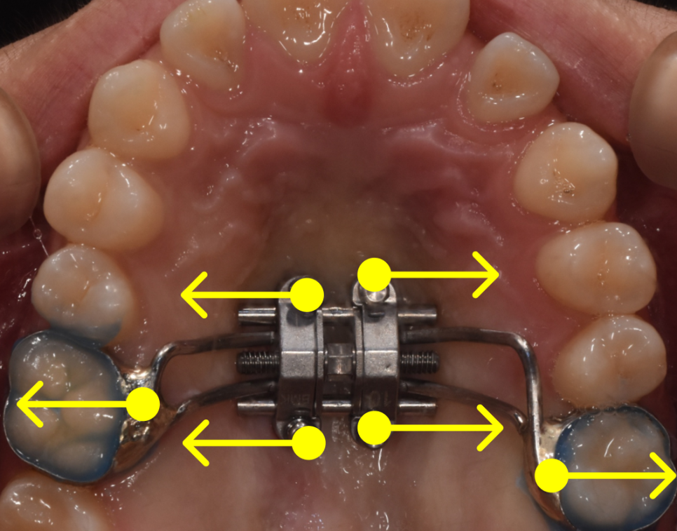 학동역 교정치과, 개방교합과 비대칭을 수술없이 교정한 경우 관련 이미지 7