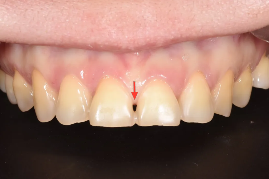 학동역 라미네이트 전후, 치아 모양과 색상 개선 사례 관련 이미지 8