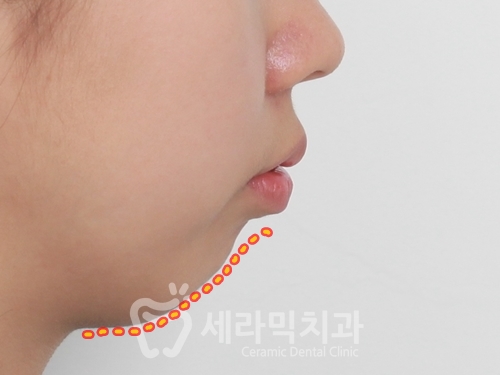 치아교정만으로 세마리 토끼를 한번에! 돌출입, 무턱, 치열불규칙 치아교정전후 관련 이미지 2