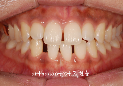 치열 교정 ( 벌어짐 ) 관련 이미지 14