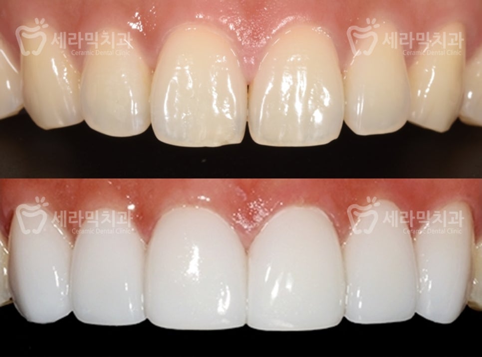 치아교정 VS. 라미네이트. 뭐가 좋은 걸까요? 관련 이미지 6