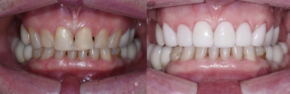 강남구청역 치과, 70대 외국인 환자의 라미네이트 관련 이미지 1