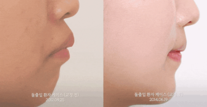 돌출입 교정 기간은 얼마나 걸릴까? 관련 이미지 7