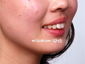 학동역치과 돌출입교정 세라믹치과에서 ~ 관련 이미지 1