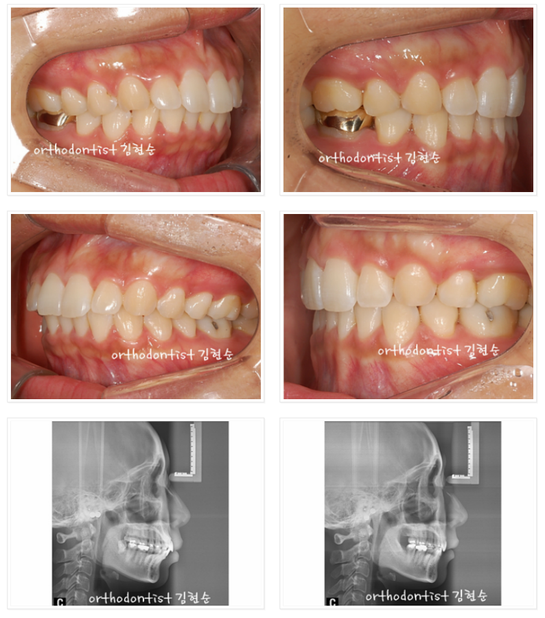 세라믹교정 세라믹치과-돌출입발치교정 7 관련 이미지 8