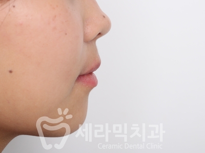 돌출입치아교정 전후사진(발치교정, 토끼이빨 인상변화) 관련 이미지 11