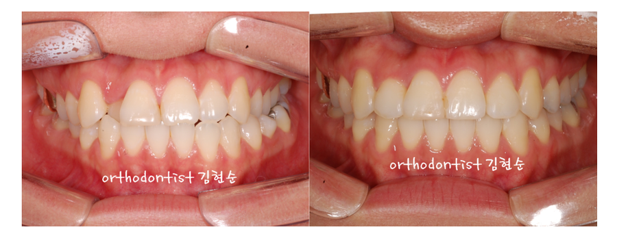 안면비대칭 교정, 치아교정만으로 간단히 해결하기 관련 이미지 17