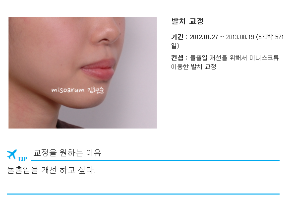 세라믹교정 세라믹치과-돌출입 발치교정 11 관련 이미지 1