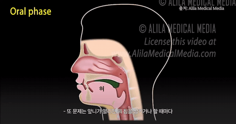 돌출입 교정 기간은 얼마나 걸릴까? 관련 이미지 3