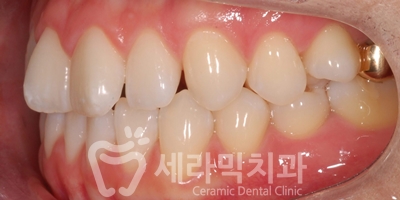앞니 돌출, 나비치아를 남몰래 해결한 치아교정 전후! 관련 이미지 9