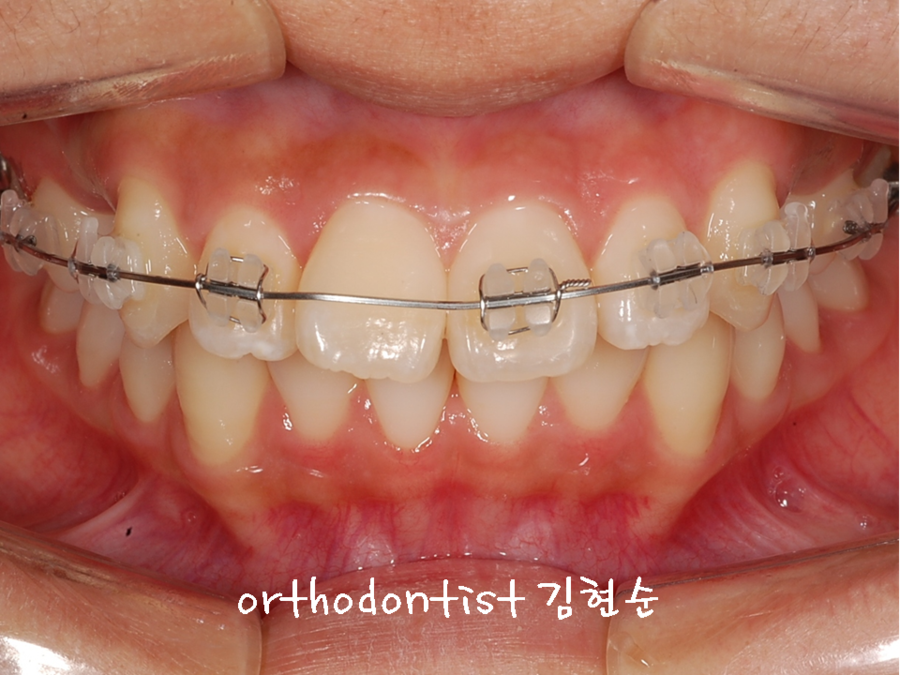 세라믹교정 은 세라믹치과 발치비발치 해결 관련 이미지 4