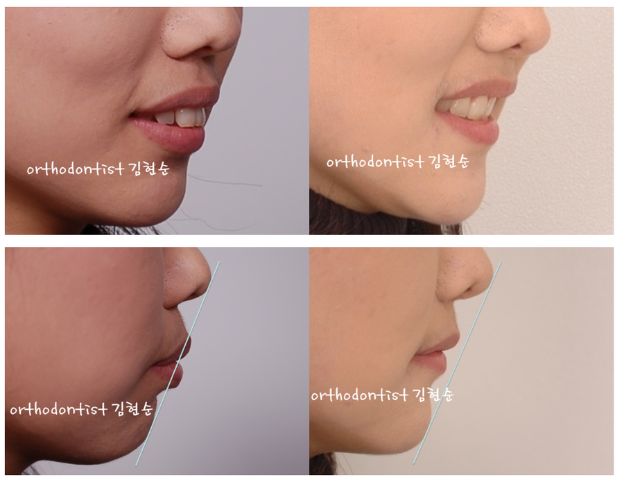 세라믹교정 세라믹치과-돌출입발치교정 10 관련 이미지 9