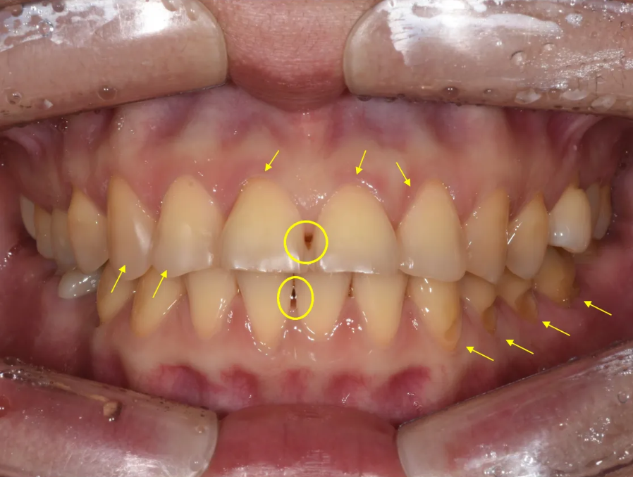 학동역 라미네이트 전후, 치아 모양과 색상 개선 사례 관련 이미지 4