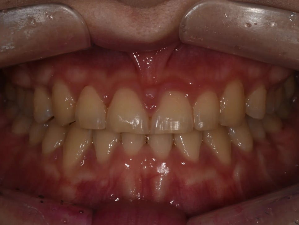 언주역 치과, 주걱턱 + 과개교합을 비수술로 치료한 사례 관련 이미지 9