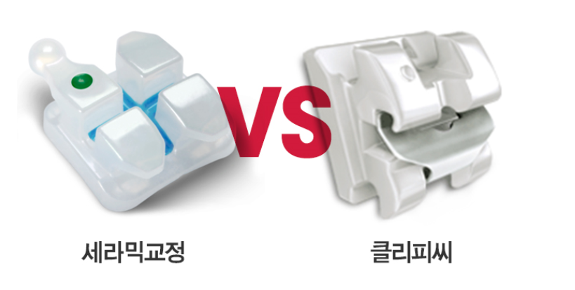 세라믹교정과 클리피씨중 선택은 ? 내 맘대로? 관련 이미지 7