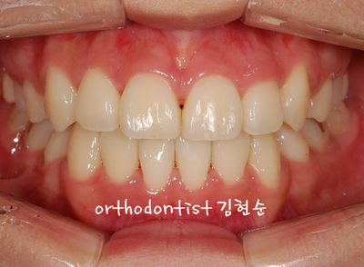 강남 덧니 관련 이미지 24