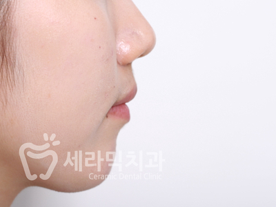 돌출입 치아교정 사례(학동역 치아교정 세라믹치과) 관련 이미지 6