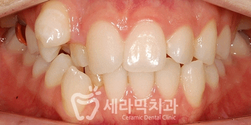 압구정교정치과, 덧니교정 잘하는곳 치아교정전후 관련 이미지 1
