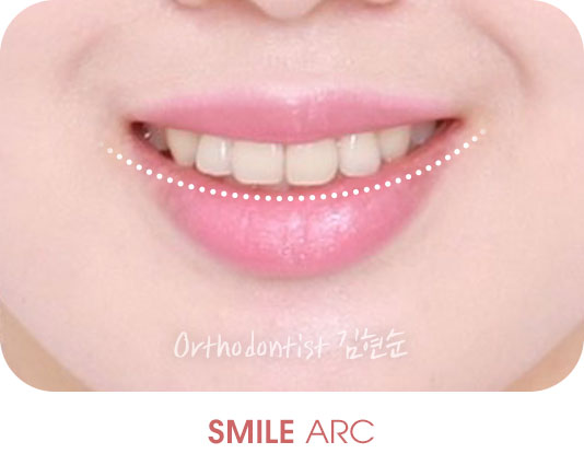 미소모양 치아교정과 스마일아크 관련 이미지 5