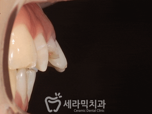 깨진 후에 후회하는 돌출입, 치아교정으로 건강하고 가지런한 치아만들기 관련 이미지 11