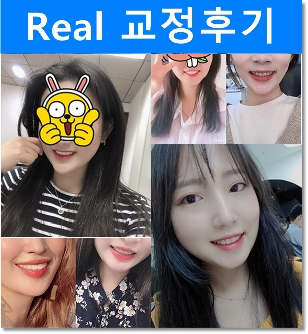 돌출입 치아교정전후. 갸름하고 세련된 입술을 되찾다! 관련 이미지 4