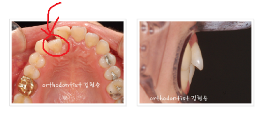 안면비대칭 교정, 치아교정만으로 간단히 해결하기 관련 이미지 6