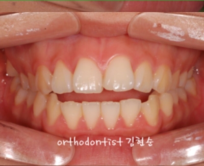 강남치아교정추천 관련 이미지 32