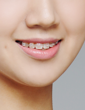 미국3M치아교정 클래러티 어드밴스 세라믹치과 관련 이미지 9