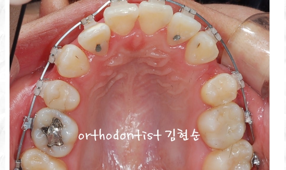 돌출입교정 / 기간 / 비용 관련 이미지 5