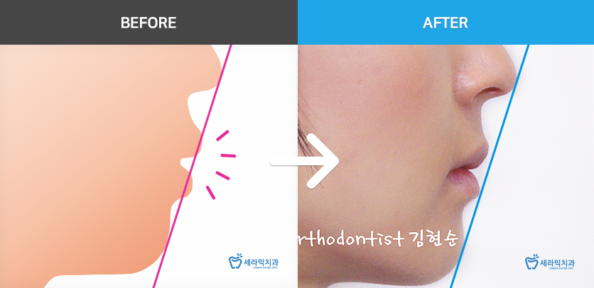 학동역치과 미국3M교정 추천 ~~ 관련 이미지 17