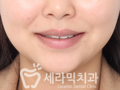 토끼이빨, 틀어진 치아배열 세라믹교정 전후사진 관련 이미지 15